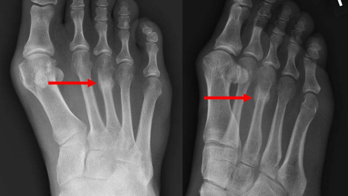 Common Stress Fractures of the Foot