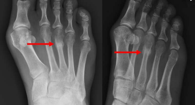 Common Stress Fractures of the Foot